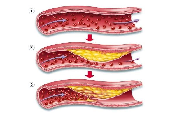 Xơ vữa động mạch liên quan gì thiếu máu não?