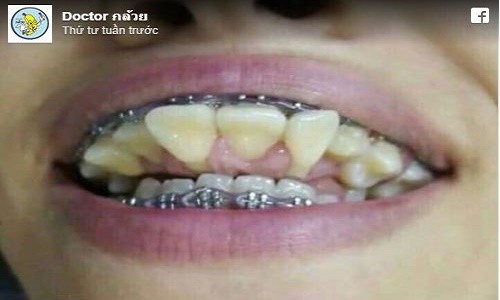 Phát hoảng với cô gái sở hữu hàm răng chĩa ngược, "chọc" vào mắt người nhìn