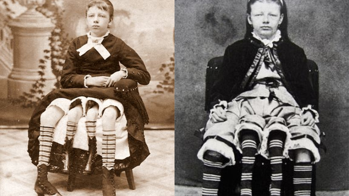 1. Josephine Myrtle Corbin: Sinh ra ở Tennessee vào năm 1868, là một trong những  dị nhân được mệnh danh là 'quái vật' trong lịch sử loài người, Josephine Myrtle Corbin bị dị tật đôi hông, nên cô có xương chậu độc lập ở hai bên eo. Cô được biết đến với biệt danh "cô gái ba chân".