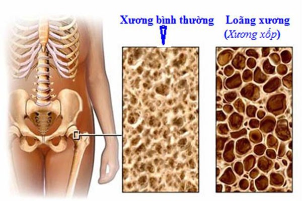 Vấn đề phổ biến nhất của những người cao tuổi là chứng loãng xương. Loãng xương có thế dẫn đến gãy xương gây ra hậu quả đáng sợ. Nhưng để biết xương của mình có đủ chắc khỏe hay không rất khó. Dưới đây là 10 dấu hiệu cùng cách khắc phục chứng loãng xương đáng được quan tâm.