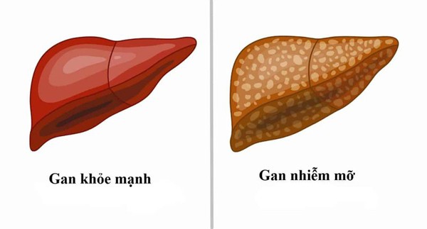  Bệnh nhân gan nhiễm mỡ được khuyên không nên ăn nhiều dầu mỡ, muối và đường. Những thực phẩm này ảnh hưởng không tốt cho quá trình điều trị, thậm chí khiến tình trạng bệnh nghiêm trọng hơn.