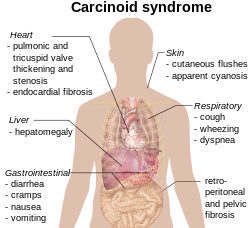 5. Một trong những loại hiếm của ung thư phổi là hội chứng carcinoid. Đây là một khối u ung thư tiết ra hóa chất (serotonin) vào máu. Những hóa chất này gây ra các dấu hiệu và triệu chứng khác nhau trong cơ thể. Đây là loại ung thư phát triển chậm, thường được chẩn đoán sau khi đã tiến triển đến giai đoạn cuối.