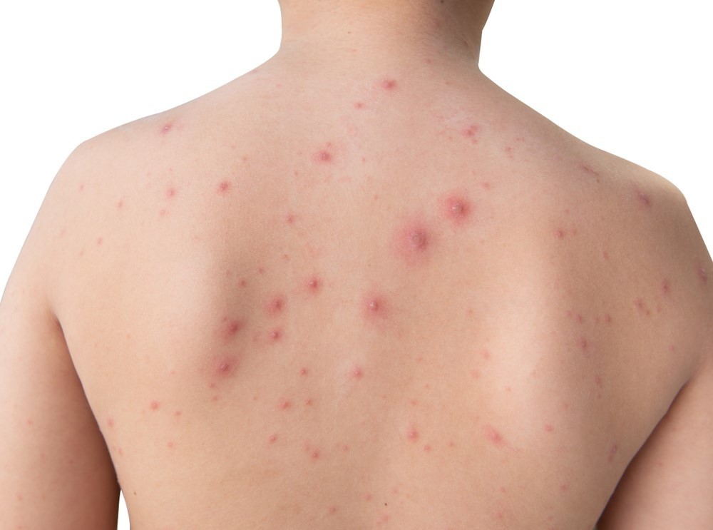  Thủy đậu là bệnh truyền nhiễm do virus varicella-zoster gây ra. Đây là bệnh thường xuất hiện ở cả trẻ em và người lớn chưa tiêm phòng với các biểu hiện như: Nhức đầu, mệt mỏi, có thể kèm sốt nhẹ, sau đó sẽ xuất hiện các nốt ban đỏ trên da. Ảnh VNC