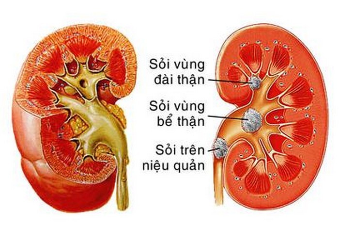 Sỏi thận là bệnh hình thành khi nước tiểu của bạn trở nên quá cô đặc với các chất nhất định nào đó. Những chất này có thể tạo ra các tinh thể nhỏ và trở thành sỏi thận. Sỏi thận có thể tự mất đi nếu như bạn có thể làm tan và tống chúng ra ngoài. Trong dân gian có một số bài thuốc chữa sỏi thận từ các loại quả vô cùng hiệu nghiệm sau đây. Ảnh: Suythan.