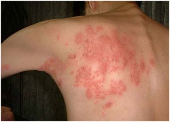 Chàm Eczema là một loại bệnh dị ứng. Nó biểu hiện trên da là những vùng đỏ ửng, ngứa rát, nặng thì bong tróc vảy. Bệnh không nguy hiểm tính mạng nhưng lại gây bất tiện trong sinh hoạt. Người bệnh có thể  chữa bệnh chàm Eczema từ củ quả sau. Ảnh: Benhvirus.