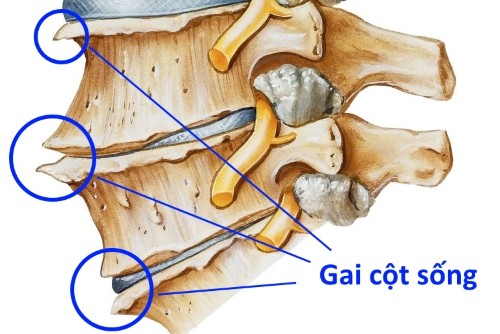 1. Dùng hạt đu đủ: Hạt đu đủ khi xanh có màu trắng và chuyển thành màu đen khi chín, có màng bọc, vị đắng. Trong hạt đu đủ có chứa papain một hoạt chất giúp làm mềm các cơ thịt, đặc biệt chúng có tác dụng “ăn mòn” các gai cột sống rất hiệu quả. Ảnh: ehospital.vn.