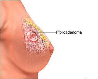 1. Chữa u xơ tuyến vú bằng dứa: Bromelain là một enzym tiêu hóa protein đặc biệt chỉ tìm thấy trong dứa rất tốt cho hệ tiêu hóa. Hệ thống miễn dịch sẽ giúp cơ thể chống lại vi khuẩn và các tác nhân gây bệnh, chữa lành vết thương, phục hồi sức khỏe. Chất bromelain trong dứa giúp tăng cường hệ miễn dịch, giảm viêm, ngăn ngừa hình thành các khối viêm và máu đông. Ảnh: sanphukhoa.info.vn.