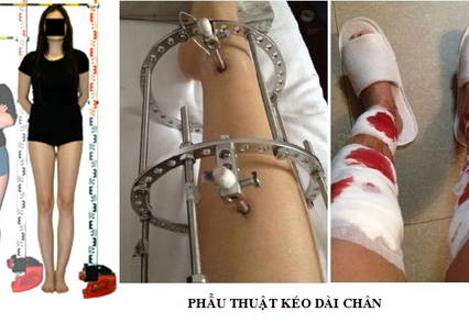 Phẫu thuật kéo dài chân là một trong những công nghệ cắt gọt chân làm đẹp kinh khủng nhất. Khi tiến hành thẩm mỹ kéo dài chân, mỗi ngày cô gái đều phải tiến hành chỉnh đinh vít 3 lần, mỗi lần đinh vít sẽ được đưa sâu vào trong khoảng 7mm.