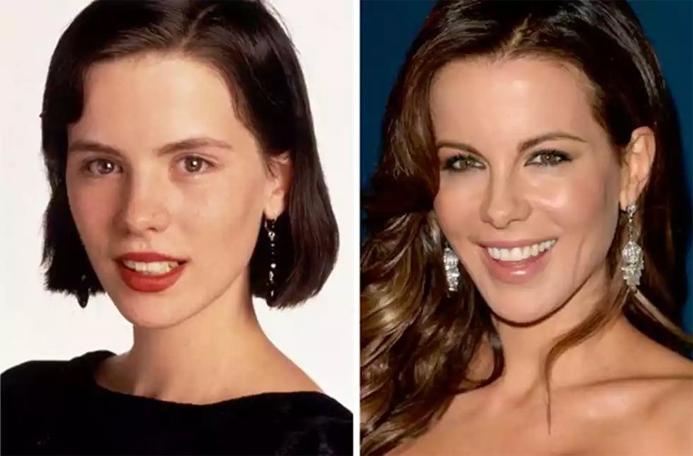 Kate Beckinsale hiện tại với cách đây 26 năm, khi lần đầu xuất hiện trên màn ảnh nhỏ, không thay đổi nét gì trên khuôn mặt. Không cần cuộc dao kéo nào, ngôi sao Underworld vẫn xinh đẹp và trẻ trung một phần là nhờ làn da mịn màng không tì vết.