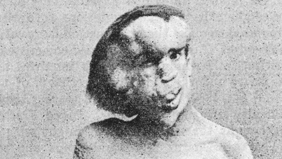  Dị nhân "người voi" Joseph Merrick chào đời tại Leicester, Anh năm 1862. Kể từ khi lên 4 tuổi, ông bắt đầu có ngoại hình dị thường so với mọi người.