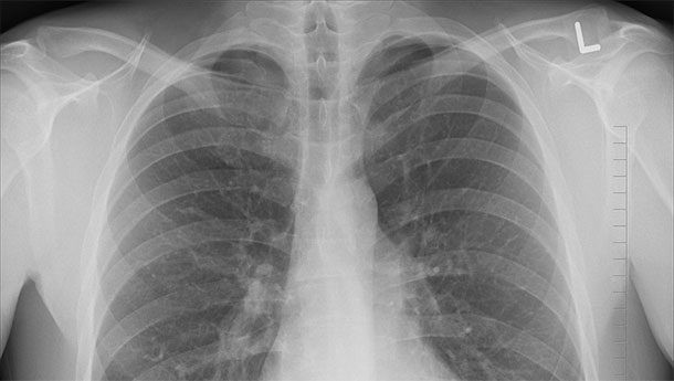 1.  Bệnh lao là một bệnh truyền nhiễm gây ra bởi vi khuẩn Mycobacterium tuberculosis. Căn bệnh chủ yếu ảnh hưởng đến phổi nhưng các bộ phận khác của cơ thể cũng có thể bị tấn công. Ảnh: Webmd.