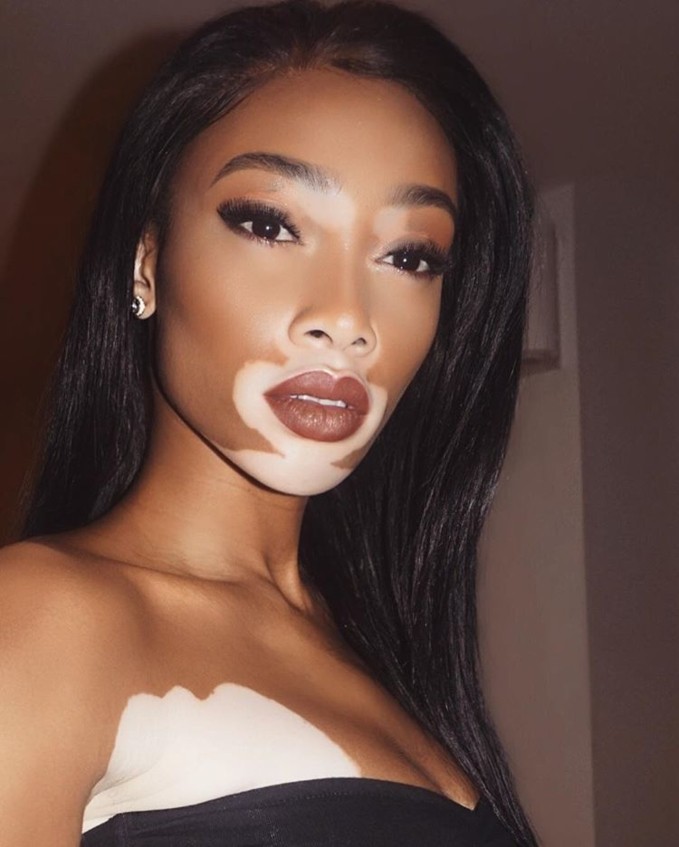 Bạch biến xuất hiện phần lớn trên da, tóc thậm chí là móng tay và chân. Winnie Harlow - một bệnh nhân bạch biến rất thành công. Ảnh: BS.