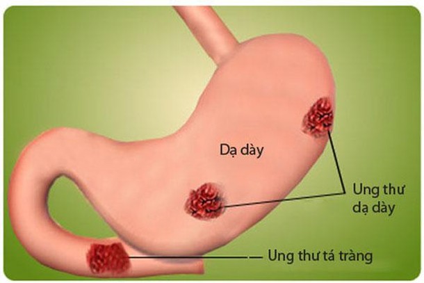 10. Ung thư dạ dày. Theo Live Science,  bệnh ung thư dạ dày bắt đầu từ các tế bào nội mạc dạ dày và thường xảy ra ở phần dưới của dạ dày. Dữ liệu trong khoảng thời gian 2003-2007 cho thấy nam giới tử vong do căn bệnh này nhiều hơn nữ giới. Di căn xảy ra ở khoảng 80-90% những người mắc bệnh ung thư dạ dày và có tỷ lệ 65% sống sót ở những người được phát biện bệnh trong giai đoạn đầu và ít hơn 15% ở những người được chẩn đoán ở giai đoạn cuối.