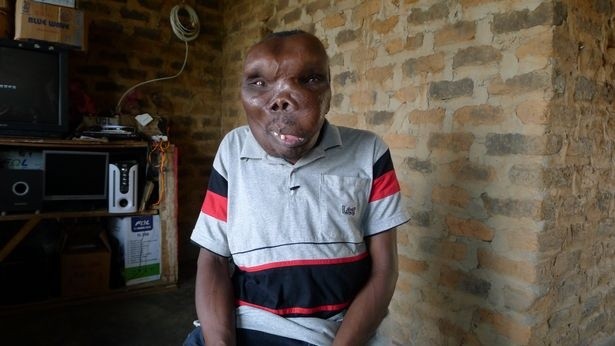 Bất chấp những khó khăn do  khuôn mặt dị thường của mình, Godfrey Baguma, 47 tuổi, người Uganda đã biến nhược điểm của mình thành ưu điểm lớn. Người đàn ông thắng giải người đàn ông dị thường nhất Uganda đã quyết định sử dụng sự nổi tiếng khác thường của mình để bắt đầu sự nghiệp âm nhạc, dòng nhạc Pop Châu Phi.