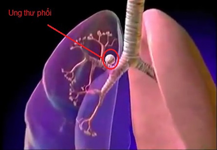 Ung thư phổi, phế quản. Ung thư phổi, phế quản được xem là nguyên nhân gây tử vong hàng đầu trong số các loại ung thư. Dù luôn nỗ lực cải thiện khả năng điều trị song tỷ lệ sống sót sau 1 năm đối với bệnh nhân ung thư phổi đạt 50%, tỷ lệ sống sót sau 5 năm chỉ còn 16%.