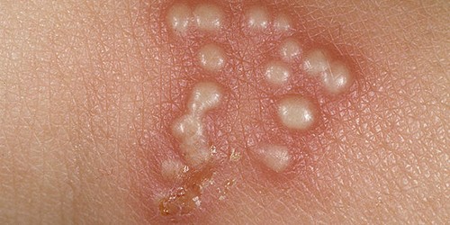 Lây truyền Herpes. Herpes là một loại bệnh mụn rộp, xuất hiện phổ biến ở các vùng như môi, mũi, má, bộ phận sinh dục và tầng sinh môn.  Bệnh nguy hiểm này lây nhiễm qua 2 loại virus Herpes Simplex (HSV).