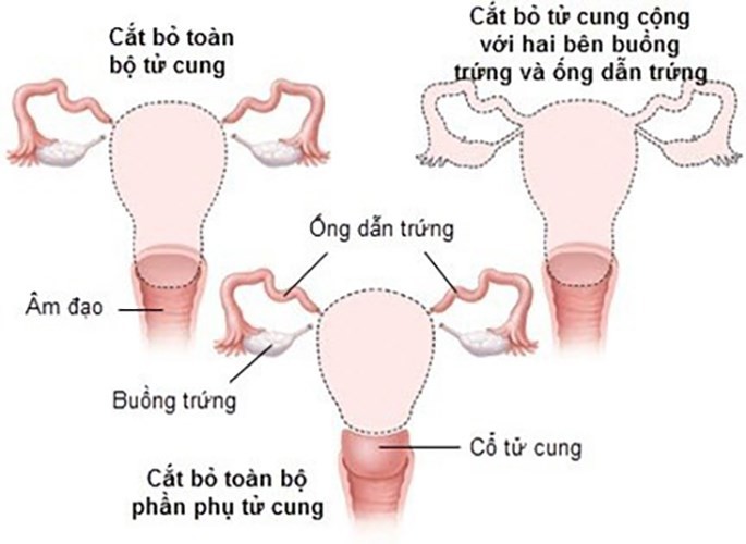 Thời gian phục hồi dài và để lại sẹo: Đây là loại tác dụng phụ thường thấy thi làm phẫu thuật  cắt bỏ tử cung. Ở đây, vết rạch thường là theo chiều dọc, trong một số trường hợp hiếm hoi, vết cắt có thể theo chiều ngang. Thông qua vết cắt này, tử cung được lấy ra khỏi cơ thể. Phương pháp này đòi hỏi bạn phải nằm trên giường trong nhiều tuần sau khi phẫu thuật. Ngoài ra, sẹo từ vết rạch rất khó để hết.