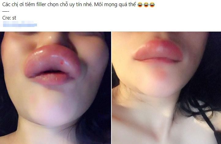  Tiêm filler môi là một phương pháp thẩm mỹ quen thuộc đối với nhiều chị em.