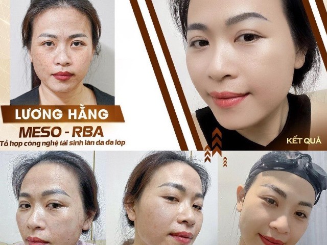 Công nghệ làm đẹp Meso-RBA đang hot tại thị trường thẩm mỹ Việt