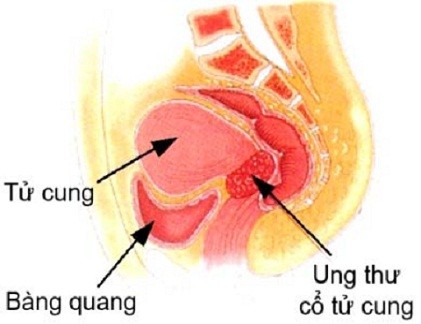 Các cách chăm sóc bệnh nhân ung thư cổ tử cung