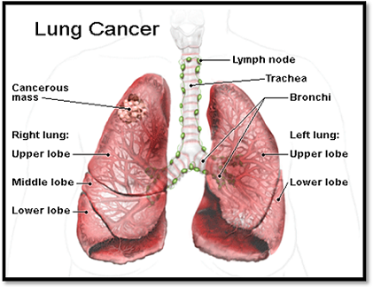 Các loại ung thư phổi thường gặp