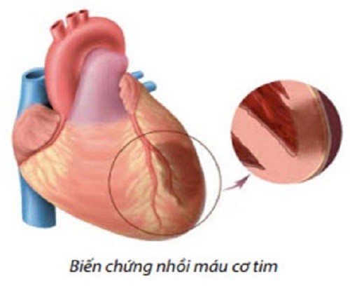 Huyết áp cao có nguy hiểm không?