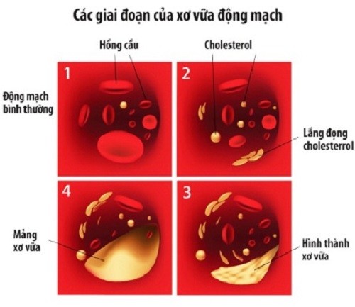 Vì sao người gầy vẫn bị rối loạn mỡ máu? 