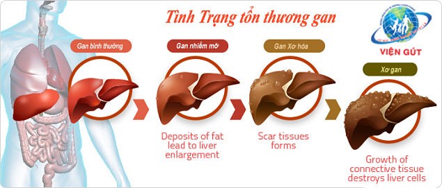 Đối tượng nào dễ mắc bệnh gan nhiễm mỡ?