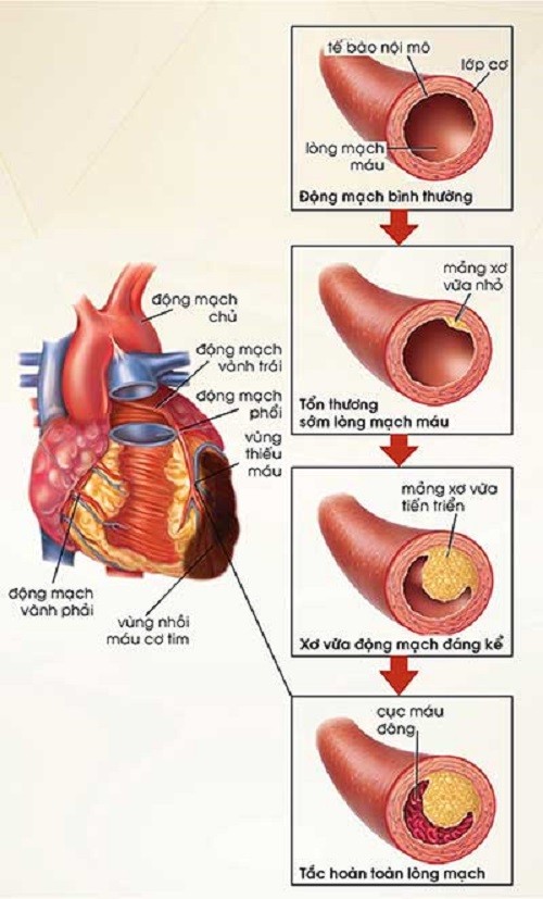 Rối loạn mỡ máu và nguy cơ các bệnh tim mạch