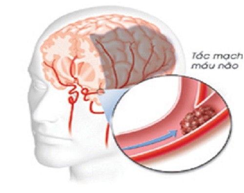 Biến chứng nguy hiểm của huyết áp cao 