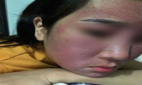 Kem trị mụn Ngọc Sâm bị “tố” gây hỏng da khách hàng