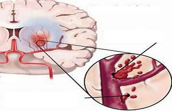 Mối liên hệ giữa đột quỵ não và cao huyết áp 