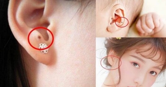 Nốt ruồi ở tai nói lên điều gì về tương lai của bạn?