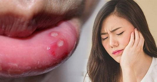 Cách chữa nhiệt miệng siêu hiệu quả mà không tốn một đồng