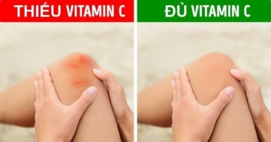 Những dấu hiệu cảnh báo bạn thiếu vitamin C trầm trọng