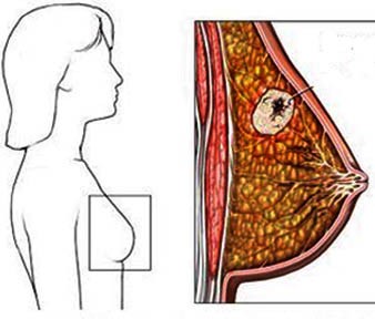 Các thuốc và nội tiết tố có thể gây ung thư