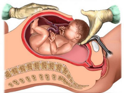 Có nên chủ động sinh mổ sớm?