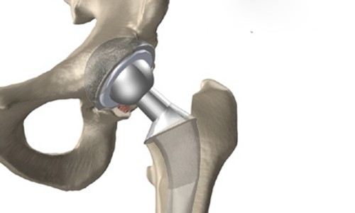 10 bệnh lý cần thay khớp háng