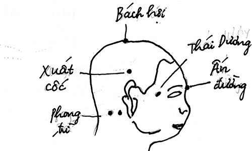 Chữa rối loạn tiền đình bằng y học cổ truyền