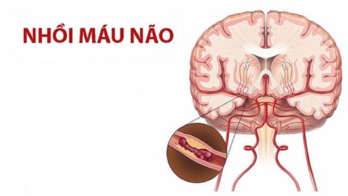 Dấu hiệu nhồi máu não nhẹ, đừng đợi mạch tắc mới khám