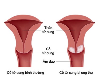 Những điều cần biết về ung thư cổ tử cung