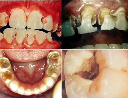 Cận cảnh thuốc lá tàn phá dữ dội sức khỏe răng miệng