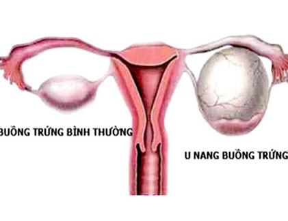 Sự khác biệt giữa ung thư buồng trứng và tử cung