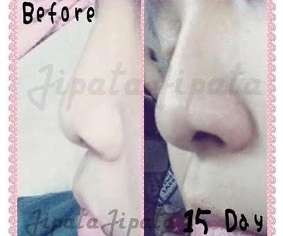 Serum nâng sống mũi: Coi chừng tiền mất tật mang