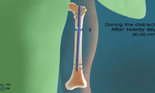 Cận cảnh quy trình phẫu thuật kéo dài chân