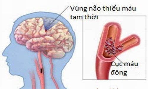 Kết hợp Đông, Tây y điều trị thiểu năng tuần hoàn não 