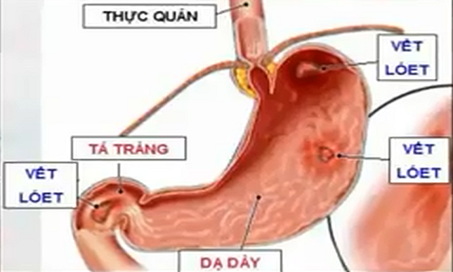 Video: Thói quen ăn uống gây ung thư dạ dày bạn cần bỏ ngay