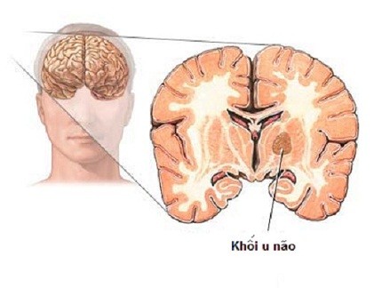 Chủng vi rút sởi có thể tiêu diệt u não trẻ em