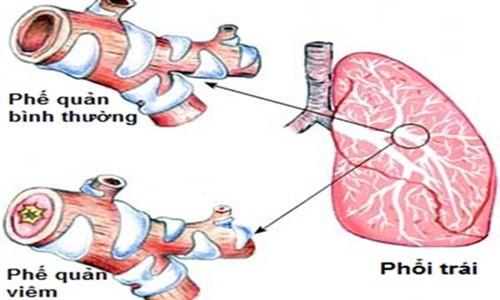 Mẹo phân biệt hen phế quản và tắc nghẽn phổi mãn tính 