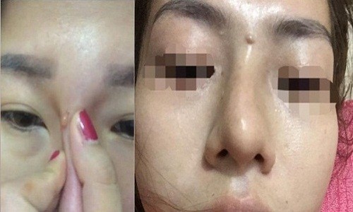 Nhận trái đắng từ trào lưu nâng mũi bằng tiêm filler